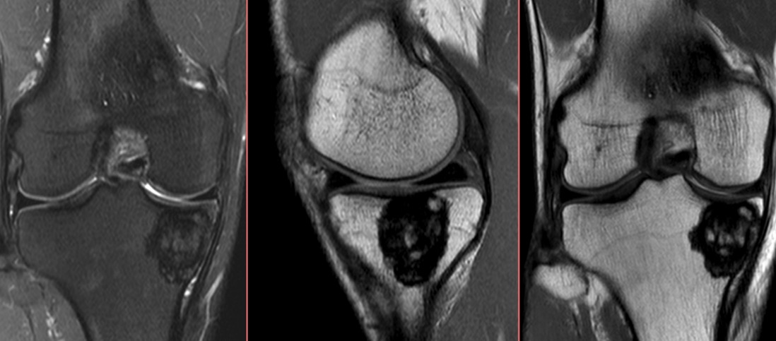 Figure 3 for case Giant cell tumor ( RID4309 )